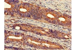 Immunohistochemistry of paraffin-embedded human colon cancer using ABIN7152309 at dilution of 1:100 (EXT2 antibody  (AA 180-267))