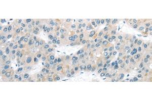 Immunohistochemistry of paraffin-embedded Human liver cancer tissue using VLDLR Polyclonal Antibody at dilution 1:40 (VLDLR antibody)
