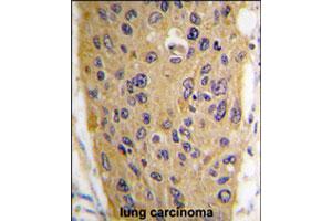 Formalin-fixed and paraffin-embedded human lung carcinoma tissue reacted with WIF1 polyclonal antibody  , which was peroxidase-conjugated to the secondary antibody, followed by DAB staining. (WIF1 antibody  (AA 350-379))