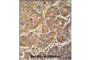 ATP5D antibody (N-term) (ABIN652148 and ABIN2840566) immunohistochemistry analysis in formalin fixed and paraffin embedded human hepatocarcinoma followed by peroxidase conjugation of the secondary antibody and DAB staining.