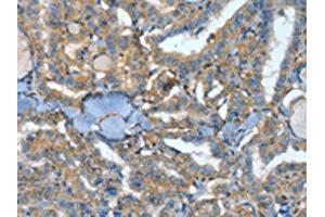 The image on the left is immunohistochemistry of paraffin-embedded Human thyroid cancer tissue using ABIN7128589(ATP4B Antibody) at dilution 1/40, on the right is treated with fusion protein. (ATP4b antibody)
