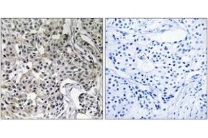 Immunohistochemistry analysis of paraffin-embedded human breast carcinoma tissue, using USP19 Antibody. (USP19 antibody  (AA 391-440))