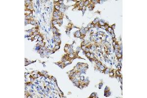 Immunohistochemistry of paraffin-embedded human lung cancer using MTIF2 antibody (ABIN7268591) at dilution of 1:100 (40x lens). (MTIF2 antibody  (AA 428-727))