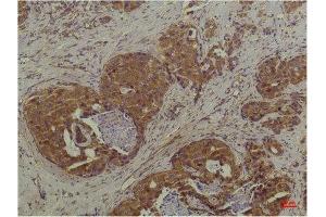 Immunohistochemistry (IHC) analysis of paraffin-embedded Human Breast Carcinoma using P44/42 MAPK (ERK1/2) Mouse Monoclonal Antibody diluted at 1:200. (ERK1/2 antibody)