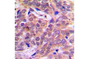 Immunohistochemical analysis of Beta-catenin (pS37) staining in human breast cancer formalin fixed paraffin embedded tissue section. (beta Catenin antibody  (N-Term, pSer37))