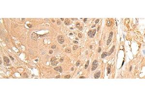 Immunohistochemistry of paraffin-embedded Human ovarian cancer tissue using MED23 Polyclonal Antibody at dilution of 1:30(x200) (MED23 antibody)