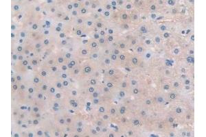 Detection of TLR3 in Human Liver cancer Tissue using Polyclonal Antibody to Toll Like Receptor 3 (TLR3) (TLR3 antibody  (AA 404-532))