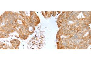 Immunohistochemistry of paraffin-embedded Human gastric cancer tissue using P2RY4 Polyclonal Antibody at dilution of 1:40(x200) (P2RY4 antibody)