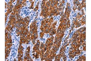 The image on the left is immunohistochemistry of paraffin-embedded Human gastic cancer tissue using ABIN7130460(NR4A2 Antibody) at dilution 1/20, on the right is treated with fusion protein. (NR4A2 antibody)
