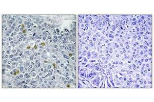 Immunohistochemistry analysis of paraffin-embedded human breast carcinoma tissue using TOP2A (Phospho-Ser1106) antibody. (Topoisomerase II alpha antibody  (pSer1106))