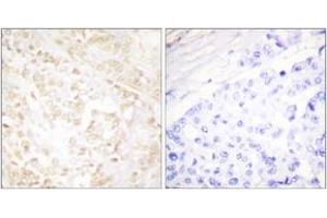 Immunohistochemistry analysis of paraffin-embedded human breast carcinoma tissue, using XRCC6 Antibody. (RCC6 (AA 554-603) antibody)