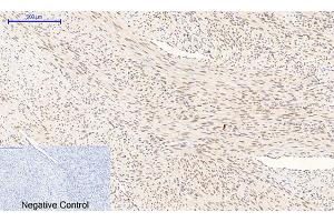Immunohistochemical analysis of paraffin-embedded human uterus cancer tissue. (MAPK14 antibody  (pThr180))