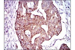 Immunohistochemical analysis of paraffin-embedded rectum cancer tissues using PDE1B mouse mAb with DAB staining. (PDE1B antibody  (AA 370-536))