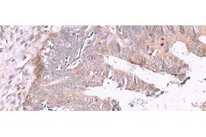Immunohistochemistry of paraffin-embedded Human colorectal cancer tissue using ZSWIM1 Polyclonal Antibody at dilution of 1:55(x200) (ZSWIM1 antibody)