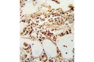 Formalin-fixed and paraffin-embedded human breast carcinoma reacted with TI Antibody (Center), which was peroxidase-conjugated to the secondary antibody, followed by DAB staining. (TIMP3 antibody  (AA 113-139))