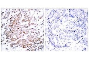 Immunohistochemical analysis of paraffin-embedded human breast carcinoma tissue using Myc (phospho-Thr58) antibody (E011034). (c-MYC antibody  (pThr58))
