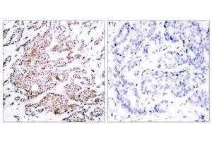 Immunohistochemical analysis of paraffin-embedded human breast carcinoma tissue using Myc (phospho-Thr58) antibody (E011034). (c-MYC antibody  (pThr58))