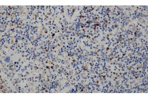 Immunohistochemistry of paraffin-embedded Human cervical cancer tissue using CD68 Polyclonal Antibody at dilution 1:30 (CD68 antibody)