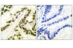 Immunohistochemical analysis of paraffin-embedded human breast carcinoma tissue using AP-2 antibody. (TFAP2A antibody)