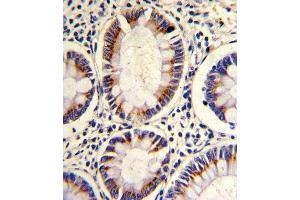 Formalin-fixed and paraffin-embedded human colon carcinoma reacted with ARGBP2 Antibody (N-term), which was peroxidase-conjugated to the secondary antibody, followed by DAB staining. (Sorbs2 antibody  (N-Term))