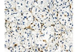 Phospho-Histone H3 (Ser28) Antibody at 1/100 staining Human kidney cancer by IHC-P. (Histone 3 antibody  (H3S28ph))