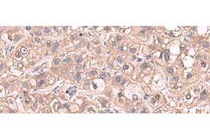 Immunohistochemistry of paraffin-embedded Human liver cancer tissue using SARS Polyclonal Antibody at dilution of 1:65(x200) (Seryl-tRNA Synthetase (SARS) antibody)