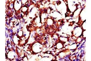 Immunohistochemistry of paraffin-embedded human gastric cancer using ABIN7146178 at dilution of 1:100
