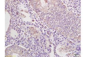 Formalin-fixed and paraffin embedded human endometrium carcinoma labeled with Rabbit Anti IRAK4 Polyclonal Antibody, Unconjugated (ABIN740310) at 1:200 followed by conjugation to the secondary antibody and DAB staining (IRAK4 antibody  (AA 21-120))
