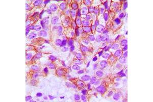 Immunohistochemical analysis of E Cadherin staining in human breast cancer formalin fixed paraffin embedded tissue section. (E-cadherin antibody  (N-Term))