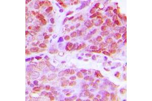 Immunohistochemical analysis of TTF1 staining in human breast cancer formalin fixed paraffin embedded tissue section. (TTF1 antibody  (N-Term))