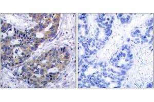 Immunohistochemistry analysis of paraffin-embedded human breast carcinoma tissue, using IRS-1 (Ab-312) Antibody. (IRS1 antibody  (AA 279-328))