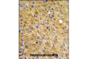 DLG7 Antibody IHC analysis in formalin fixed and paraffin embedded hepatocarcinoma followed by peroxidase conjugation of the secondary antibody and DAB staining. (DLGAP5 antibody  (AA 228-258))