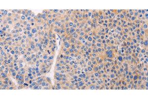 Immunohistochemistry of paraffin-embedded Human liver cancer using ADCY1 Polyclonal Antibody at dilution of 1:60 (ADCY1 antibody)
