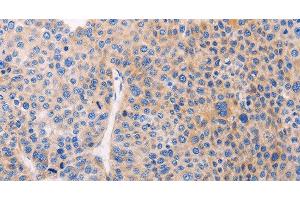 Immunohistochemistry of paraffin-embedded Human liver cancer using ADCY1 Polyclonal Antibody at dilution of 1:60