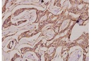 Immunohistochemical analysis of paraffin-embedded human breast cancer tissue using IgG1 polyclonal antibody . (Rabbit anti-Human IgG1 (AA 211-260) Antibody)