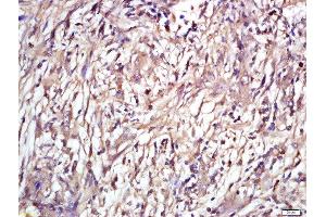 Formalin-fixed and paraffin embedded human laryngeal tissue labeled with Rabbit Anti-ENT2 Polyclonal Antibody, Unconjugated (ABIN2559658) at 1:200 followed by conjugation to the secondary antibody and DAB staining (SLC29A2 antibody  (AA 221-320))