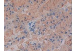 Detection of Slit1 in Human Stomach cancer Tissue using Polyclonal Antibody to Slit Homolog 1 (Slit1) (SLIT1 antibody  (AA 603-773))