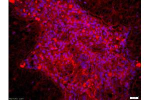 Formalin-fixed and paraffin embedded human laryngocarcinoma labeled with Anti Dyrk1B Polyclonal Antibody, Unconjugated (ABIN716501) at 1:200 followed by conjugation to the secondary antibody Goat Anti-Rabbit IgG, Cy3 conjugated used at 1:200 dilution for 40 minutes at 37°C and DAPI staining (DYRK1B antibody  (AA 35-130))