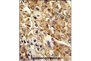 Formalin-fixed and paraffin-embedded human hepatocarcinoma reacted with ATP1B2 Antibody (Center), which was peroxidase-conjugated to the secondary antibody, followed by DAB staining. (ATP1B2 antibody  (AA 115-141))