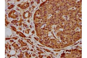 IHC image of ABIN7169092 diluted at 1:300 and staining in paraffin-embedded human colon cancer performed on a Leica BondTM system.