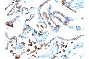 FFPE human lung carcinoma tested with MFGE8 antibody (MFG-06) (MFGE8 antibody)