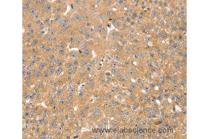 Immunohistochemistry of Human breast cancer using SNX2 Polyclonal Antibody at dilution of 1:40