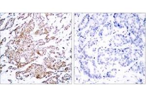 Immunohistochemistry analysis of paraffin-embedded human breast carcinoma, using Myc (Phospho-Thr58) Antibody.