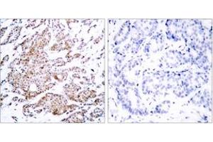 Immunohistochemistry analysis of paraffin-embedded human breast carcinoma, using Myc (Phospho-Thr58) Antibody. (c-MYC antibody  (pThr58))