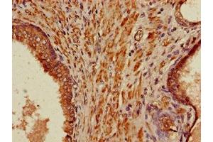 Immunohistochemistry of paraffin-embedded human prostate cancer using ABIN7165984 at dilution of 1:100 (PIH1D3 antibody  (AA 1-214))
