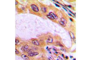 Immunohistochemical analysis of B4GALT3 staining in human liver cancer formalin fixed paraffin embedded tissue section. (B4GALT3 antibody  (Center))
