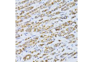 Immunohistochemistry of paraffin-embedded human colon carcinoma using CCDC92 antibody (ABIN5974817) at dilution of 1/100 (40x lens). (CCDC92 antibody)