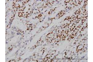Immunoperoxidase of monoclonal antibody to MCM7 on formalin-fixed paraffin-embedded human ovary, clear cell carcinoma. (MCM7 antibody  (AA 1-389))