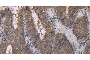 Immunohistochemistry of paraffin-embedded Human colon cancer using CUL3 Polyclonal Antibody at dilution of 1:30 (Cullin 3 antibody)