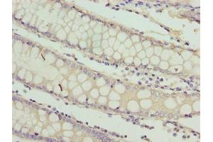 Immunohistochemistry of paraffin-embedded human colon cancer using ABIN7167326 at dilution of 1:100 (RAB3B antibody  (AA 1-219))